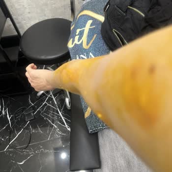 Suit Marina Güzellik Merkezinde Tüm Vücudum Lazerden Yandı