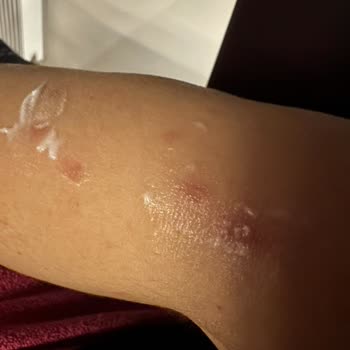 Suit Marina Güzellik Merkezinde Tüm Vücudum Lazerden Yandı