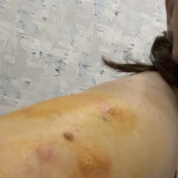 Suit Marina Güzellik Merkezinde Tüm Vücudum Lazerden Yandı