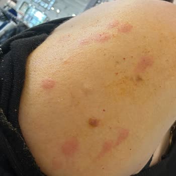 Suit Marina Güzellik Merkezinde Tüm Vücudum Lazerden Yandı