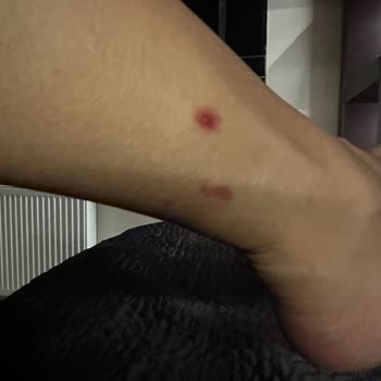 Suit Marina Güzellik Merkezinde Tüm Vücudum Lazerden Yandı