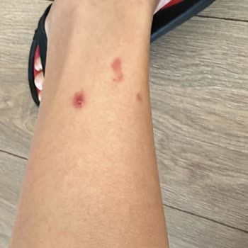 Suit Marina Güzellik Merkezinde Tüm Vücudum Lazerden Yandı