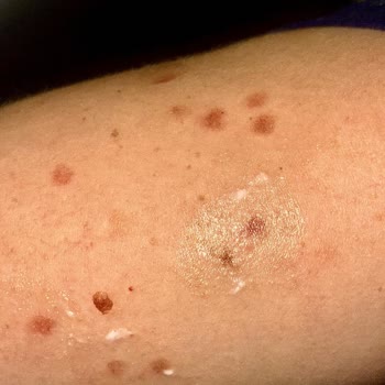 Suit Marina Güzellik Merkezinde Tüm Vücudum Lazerden Yandı