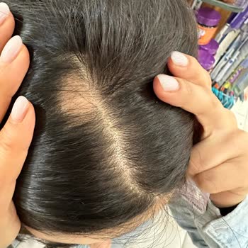 Saç Kaynak Atölyesi (Bakırköy) Saç Kaynak Sonrası Beklenmedik Sorunlar Ve Mağduriyet