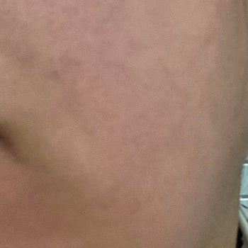 Gratis Çok Kötü Yüzüm Yanıyor Şikayetçiyim