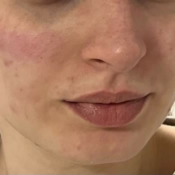 La Roche - Posay Yüzümde Yanma Ve Kızarıklık Var