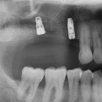 Dentsply Sirona Görüntüleme Sistemleri İsveç Astra İmplant Parçalarını Yanlış Gönderiyor