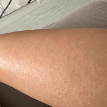 Agiss Marka Ağda Yüzümü Mahvetti