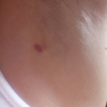 Mina Güzellik Salonu Lazer Epilasyon Faciası