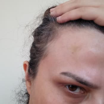 Rumeysa Güzel Güzellik & Bakım Gebze İsteğim Dışında Yanlış Botoks İşlemi Yaptı