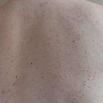 Sağlık Bakanlığı Uyuz Hastalığı Hakkında