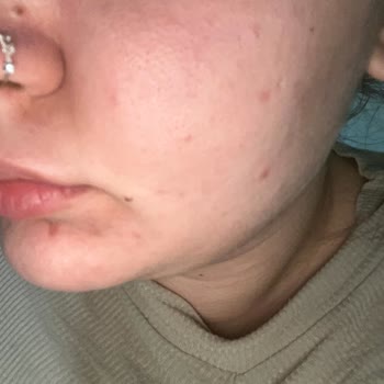 Garnier C Vitamini Serum Yüzümde Sivilce Yaptı