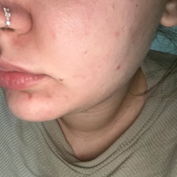 Garnier Vitamin C Skincare Products Caused Severe Acne