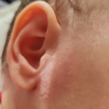 Mustela Şampuan Ve Temizleme Suyu Bebeğime Alerji Ve Egzama Yaptı