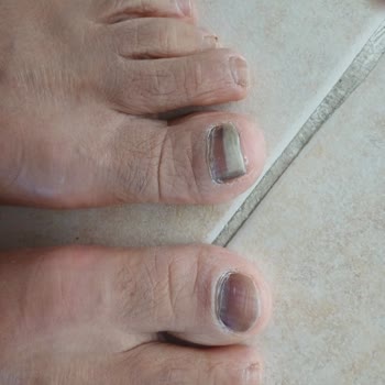 Skechers Dlites Ayakkabının Zararı