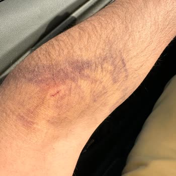 Türk Kızılay Damarım Patladı