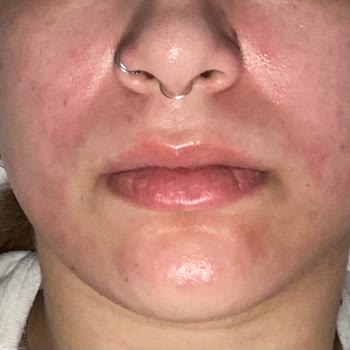 La Roche Posay- Cicaplast Baume B5 Yüzümü Yaktı!