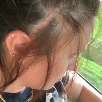 Novita Estetik Merkezi Şakak Germe Operasyonu