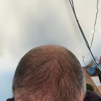 Atlas Hair Center Fiyaskosu