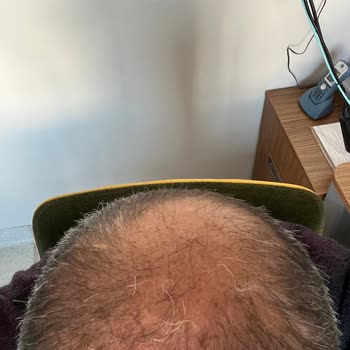 Atlas Hair Center Fiyaskosu