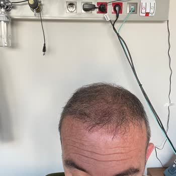 Atlas Hair Center Fiyaskosu