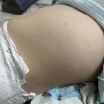 Ozmo Sürpriz Yumurta Alerji Yaptı!