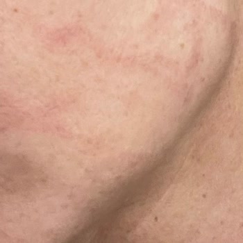 Rönesans Vip Güzellik Salonu Hifu İle Yüzümü Yaktılar
