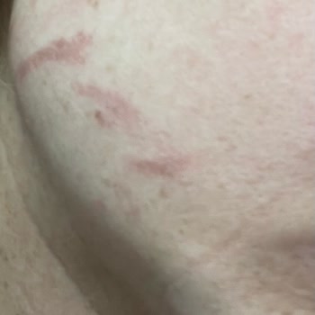 Rönesans Vip Güzellik Salonu Hifu İle Yüzümü Yaktılar