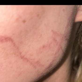 Rönesans Vip Güzellik Salonu Hifu İle Yüzümü Yaktılar