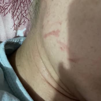 Rönesans Vip Güzellik Salonu Hifu İle Yüzümü Yaktılar