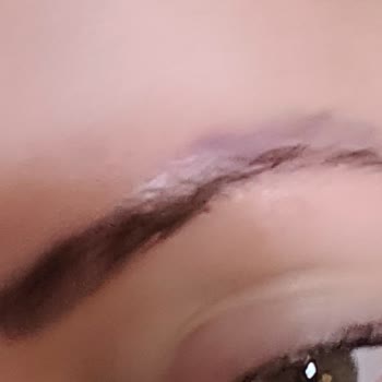 Özel FGM Polikliniği Mikroblading İşlemi Sonrası