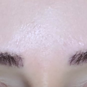 Özel FGM Polikliniği Mikroblading İşlemi Sonrası