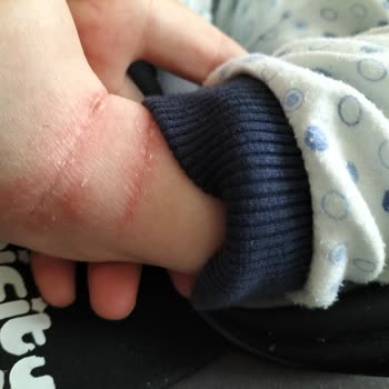 Mustela Atopik Şampuan Yara Yapıyor