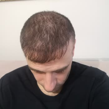 Esma Serkan Tetik Saç Ekim Merkezi Hayal Kırıklığı, Beklenen Sonuçların Uzağında