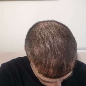 Esma Serkan Tetik Saç Ekim Merkezi Hayal Kırıklığı, Beklenen Sonuçların Uzağında