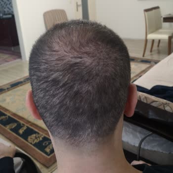 Esma Serkan Tetik Saç Ekim Merkezi Hayal Kırıklığı, Beklenen Sonuçların Uzağında