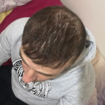 Esma Serkan Tetik Saç Ekim Merkezi Hayal Kırıklığı, Beklenen Sonuçların Uzağında