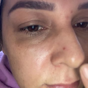 New Well Kremleri Koruyucuları Sivilce Yaptı