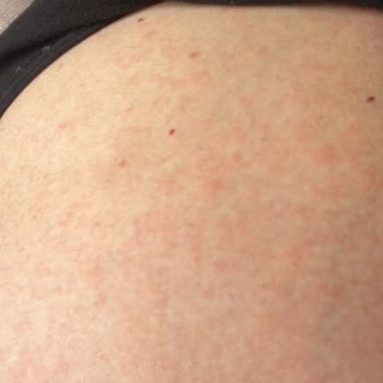 Mustela Kaşıntı Kabarcıklı Kırmızı Lekeler