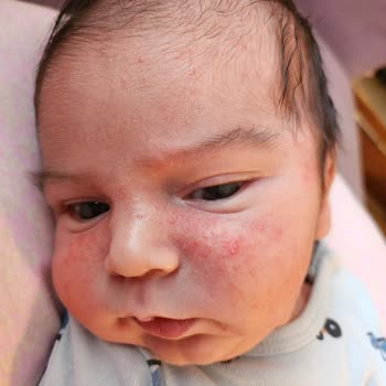 Sma Optipro 1 Mama Şikayeti