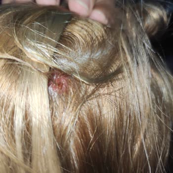 Palette 10.1 Boyası Kafa Derimi Yara İçinde Bıraktı