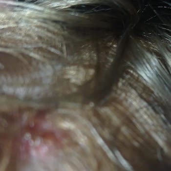 Palette 10.1 Boyası Kafa Derimi Yara İçinde Bıraktı