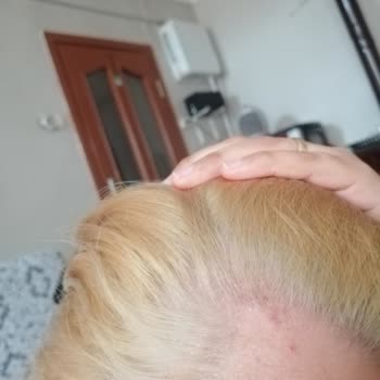 Palette Saç Boyası Saç Derimde Yara Yaptı Derimi Yaktı