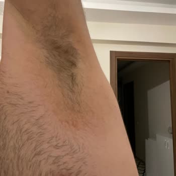 NIVEA Deodorant Caused Skin Irritation