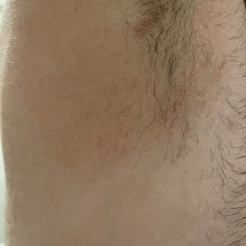 NIVEA Deodorant Caused Skin Irritation