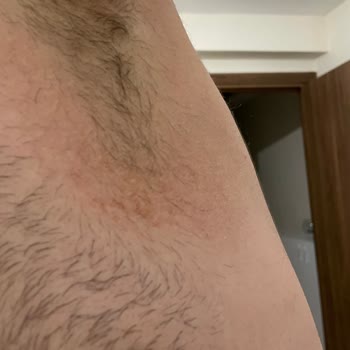 NIVEA Deodorant Caused Skin Irritation