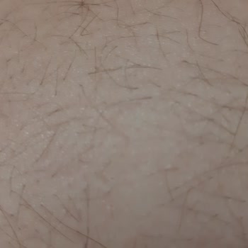 Suit Güzellik Merkezleri Lazer Epilasyon Mağduru