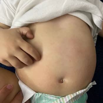 Duaderm Bariyer Krem Kaşıntı Ve Kızarıklık Yapıyor