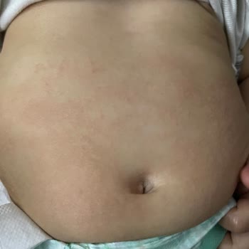 Duaderm Bariyer Krem Kaşıntı Ve Kızarıklık Yapıyor