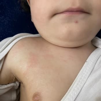 Duaderm Bariyer Krem Kaşıntı Ve Kızarıklık Yapıyor